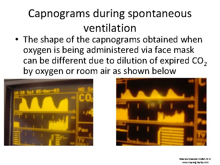 Capnograms during spontaneous ventilation • The shape of the capnograms obtained when oxygen is