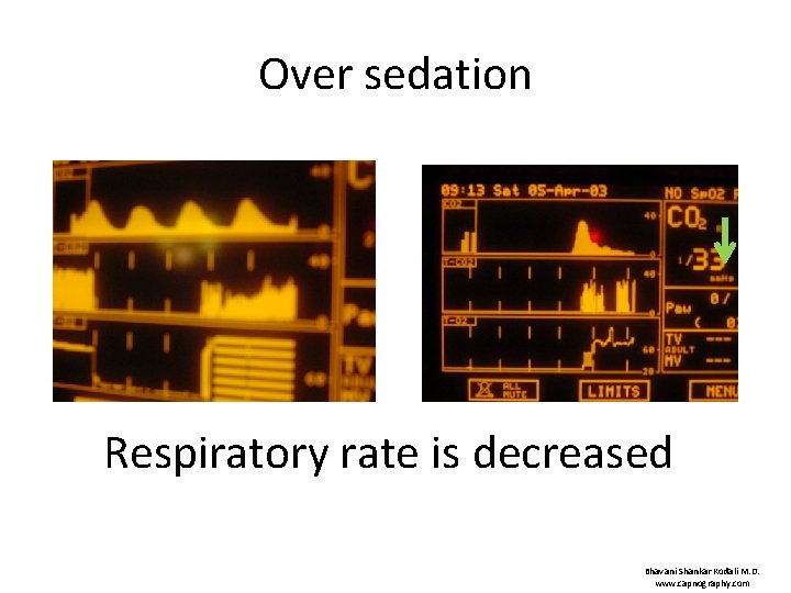 Over sedation Respiratory rate is decreased Bhavani Shankar Kodali M. D. www. capnography. com