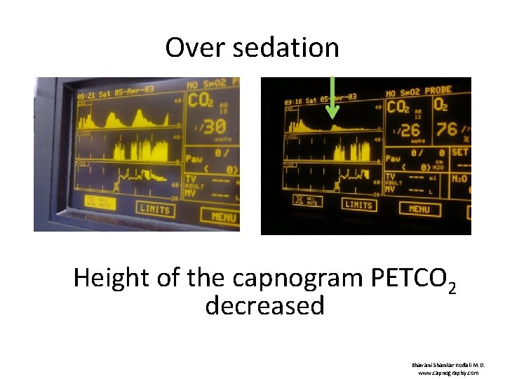 Over sedation Height of the capnogram PETCO 2 decreased Bhavani Shankar Kodali M. D.