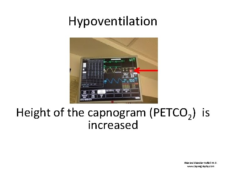 Hypoventilation Height of the capnogram (PETCO 2) is increased Bhavani Shankar Kodali M. D.