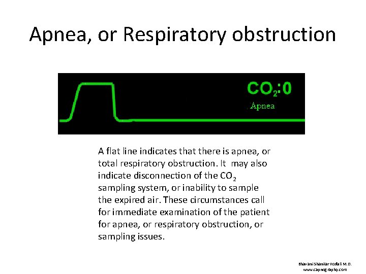 Apnea, or Respiratory obstruction A flat line indicates that there is apnea, or total
