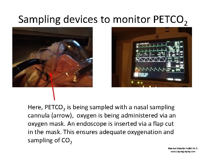 Sampling devices to monitor PETCO 2 Here, PETCO 2 is being sampled with a