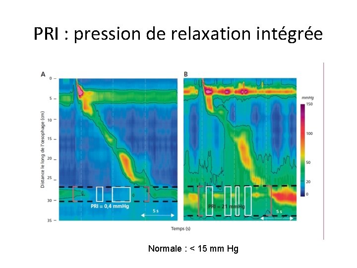 PRI : pression de relaxation intégrée Normale : < 15 mm Hg 