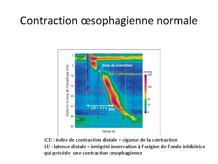 Contraction œsophagienne normale ICD : index de contraction distale = vigueur de la contraction