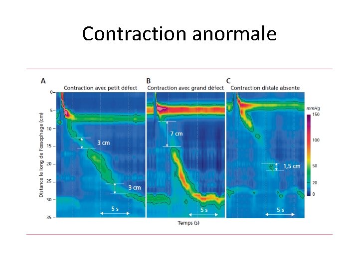 Contraction anormale 