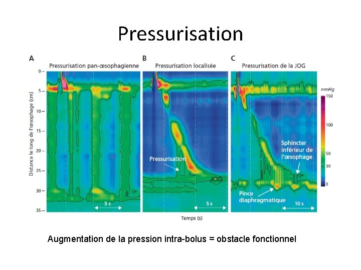 Pressurisation Augmentation de la pression intra-bolus = obstacle fonctionnel 