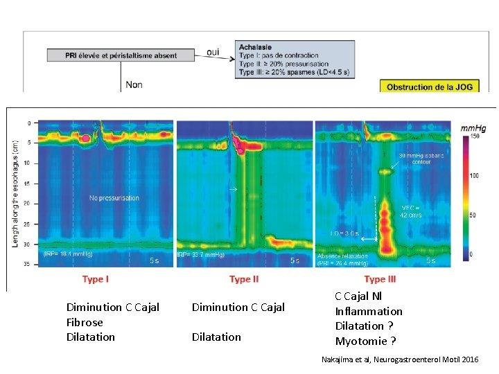 Diminution C Cajal Fibrose Dilatation Diminution C Cajal Dilatation C Cajal Nl Inflammation Dilatation