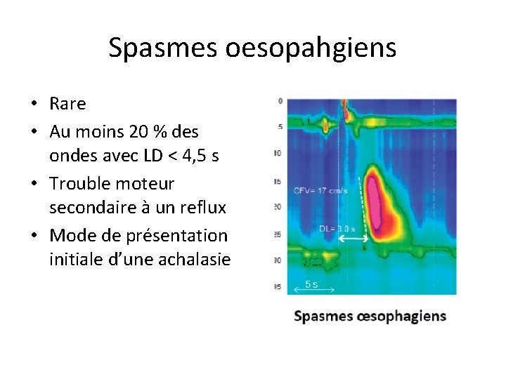 Spasmes oesopahgiens • Rare • Au moins 20 % des ondes avec LD <