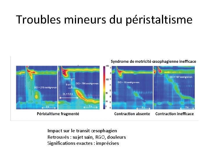Troubles mineurs du péristaltisme Impact sur le transit œsophagien Retrouvés : sujet sain, RGO,