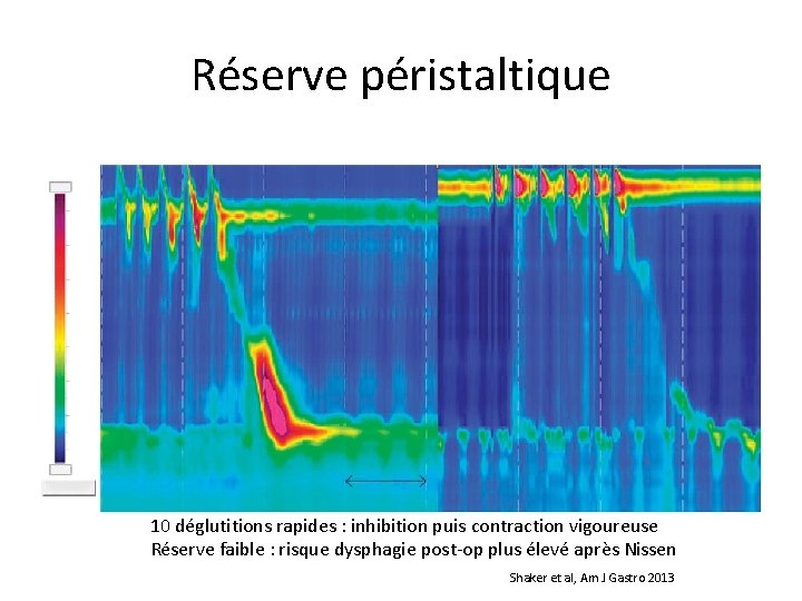 Réserve péristaltique 10 déglutitions rapides : inhibition puis contraction vigoureuse Réserve faible : risque