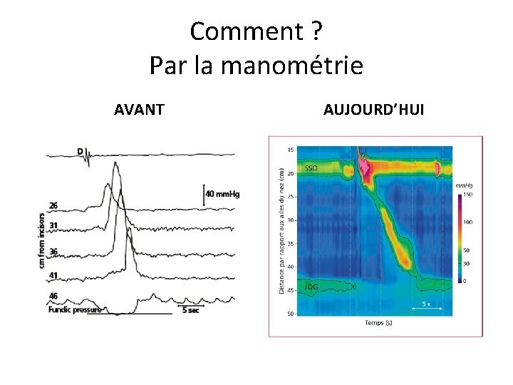 Comment ? Par la manométrie AVANT AUJOURD’HUI 