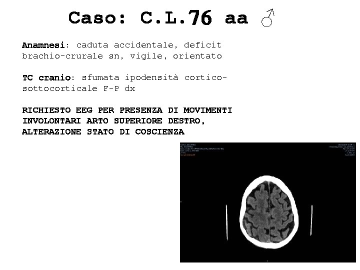 Caso: C. L. 76 aa ♂ Anamnesi: caduta accidentale, deficit brachio-crurale sn, vigile, orientato