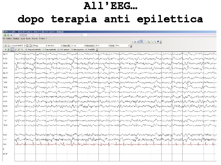 All’EEG… dopo terapia anti epilettica 