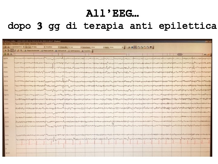 All’EEG… dopo 3 gg di terapia anti epilettica 