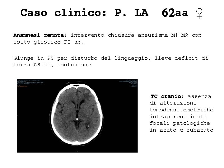 Caso clinico: P. LA 62 aa ♀ Anamnesi remota: intervento chiusura aneurisma M 1