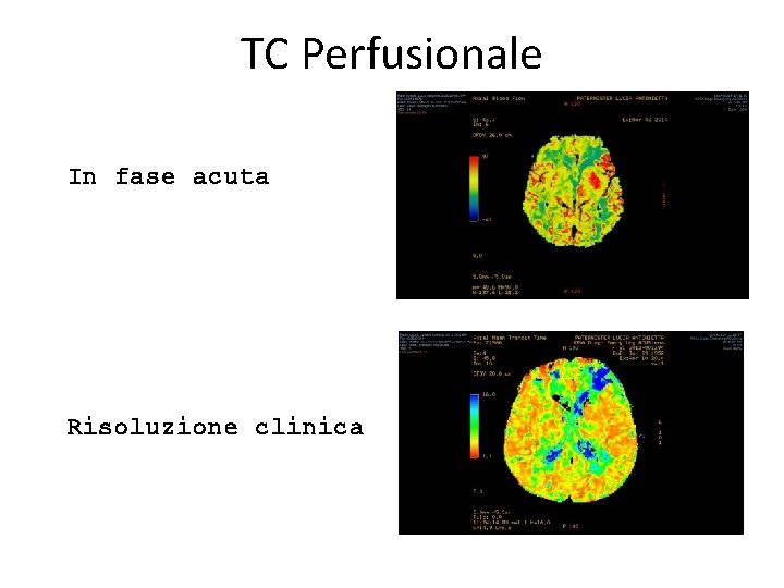 TC Perfusionale In fase acuta Risoluzione clinica 