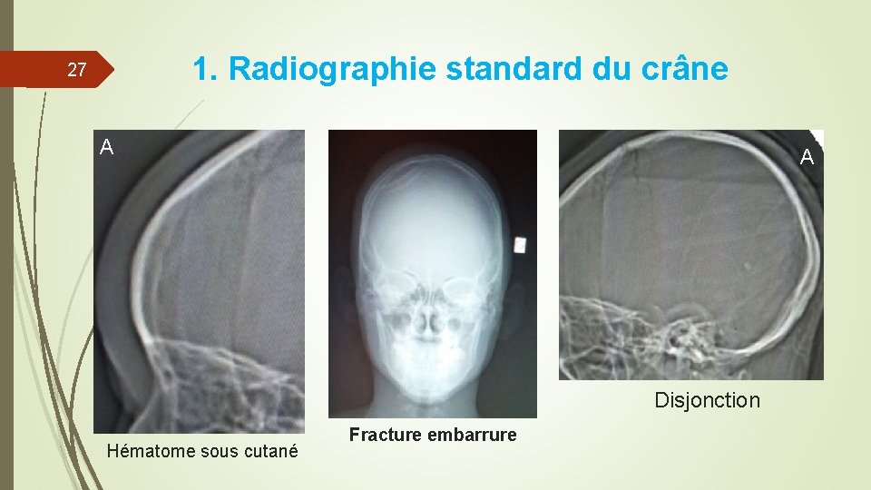 1. Radiographie standard du crâne 27 A A Disjonction Hématome sous cutané Fracture embarrure 1. Radiographie standard du crâne 27 A A Disjonction Hématome sous cutané Fracture embarrure