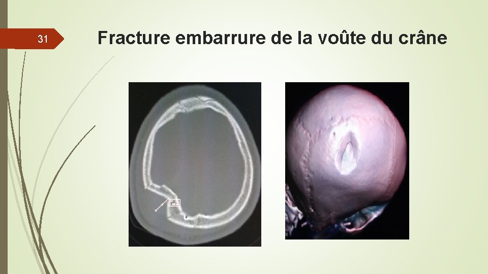 31 Fracture embarrure de la voûte du crâne 31 Fracture embarrure de la voûte du crâne