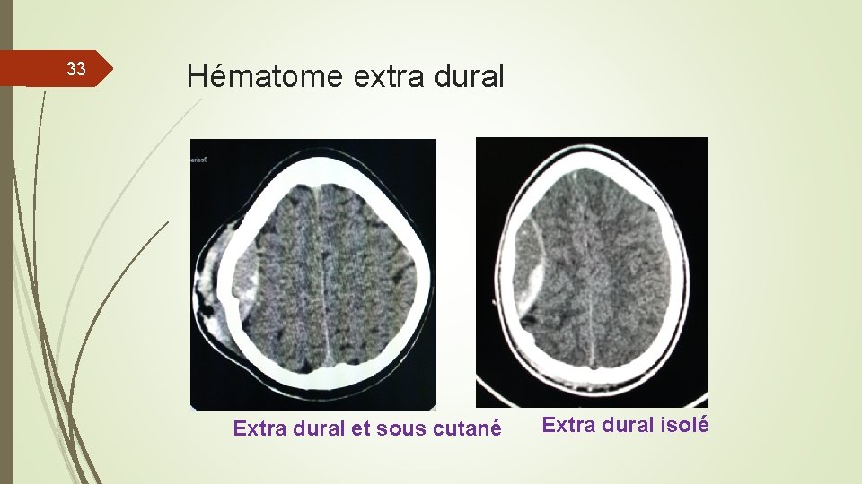 33 Hématome extra dural Extra dural et sous cutané Extra dural isolé 33 Hématome extra dural Extra dural et sous cutané Extra dural isolé
