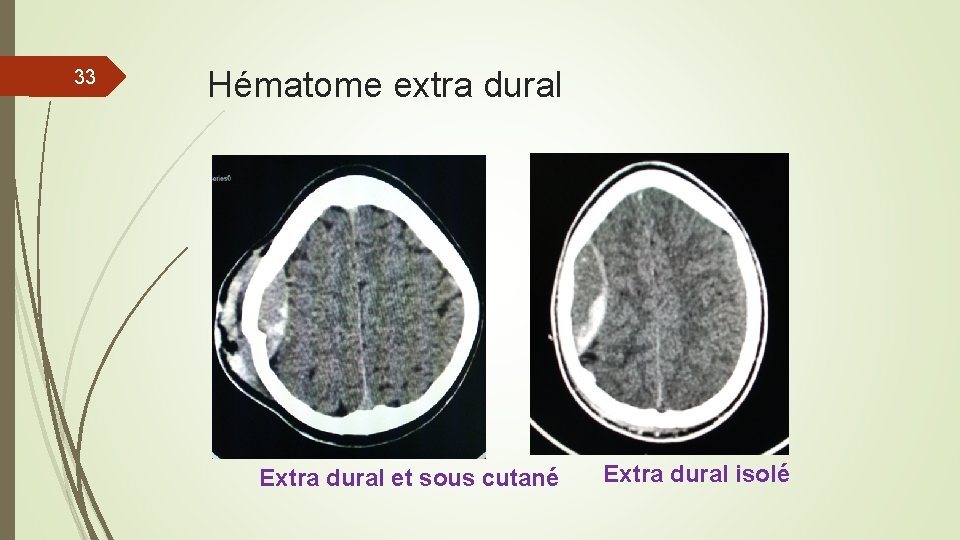 33 Hématome extra dural Extra dural et sous cutané Extra dural isolé 