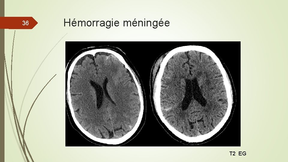36 Hémorragie méningée T 2 EG 36 Hémorragie méningée T 2 EG