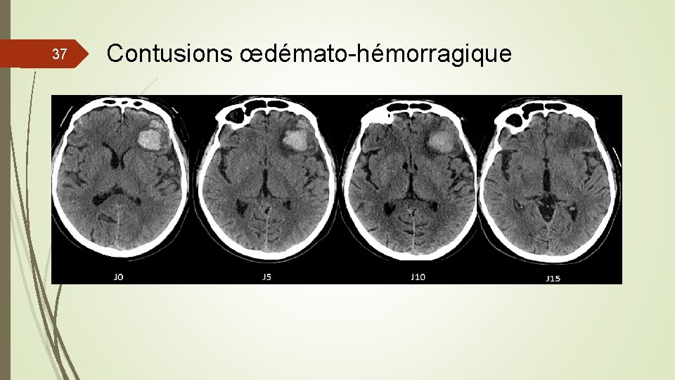 37 Contusions œdémato-hémorragique 37 Contusions œdémato-hémorragique