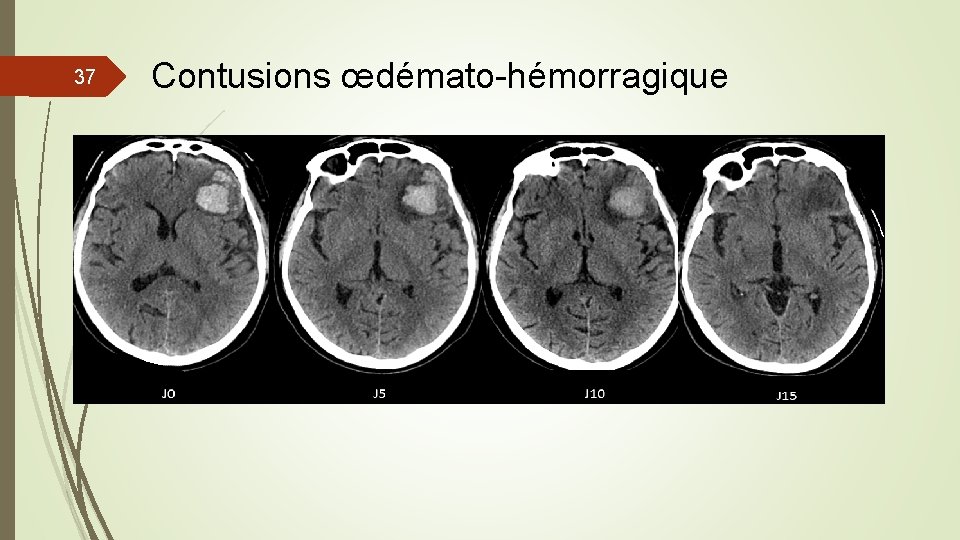 37 Contusions œdémato-hémorragique 