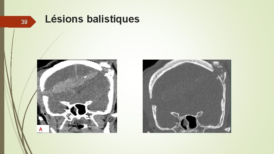 Lésions balistiques 39 A Lésions balistiques 39 A