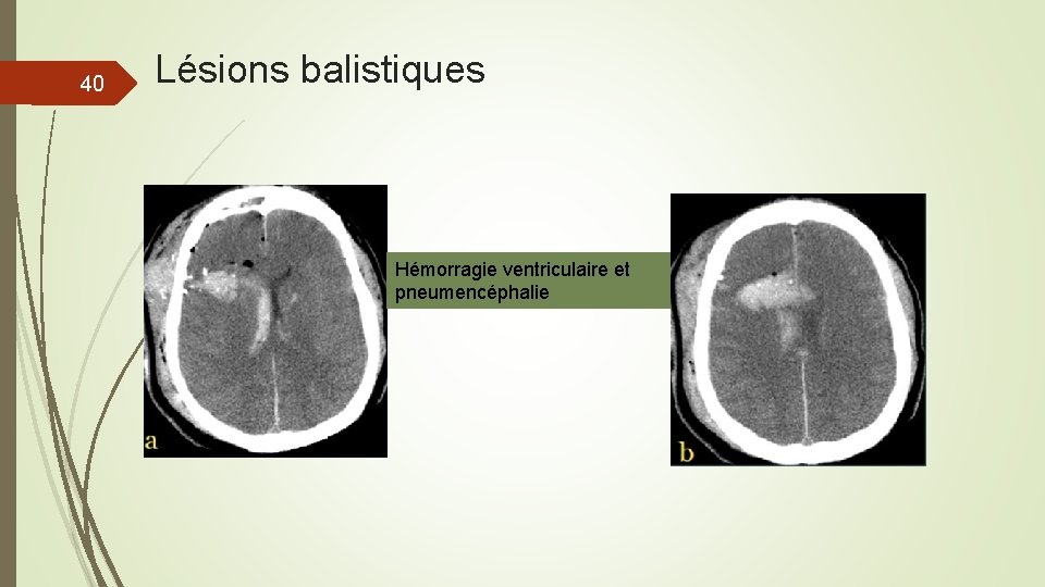 40 Lésions balistiques Hémorragie ventriculaire et pneumencéphalie 40 Lésions balistiques Hémorragie ventriculaire et pneumencéphalie