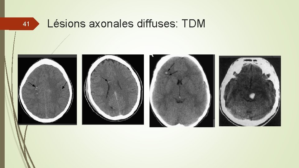 41 Lésions axonales diffuses: TDM 41 Lésions axonales diffuses: TDM