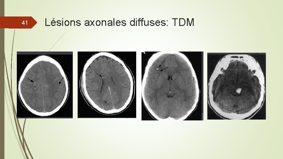 41 Lésions axonales diffuses: TDM 