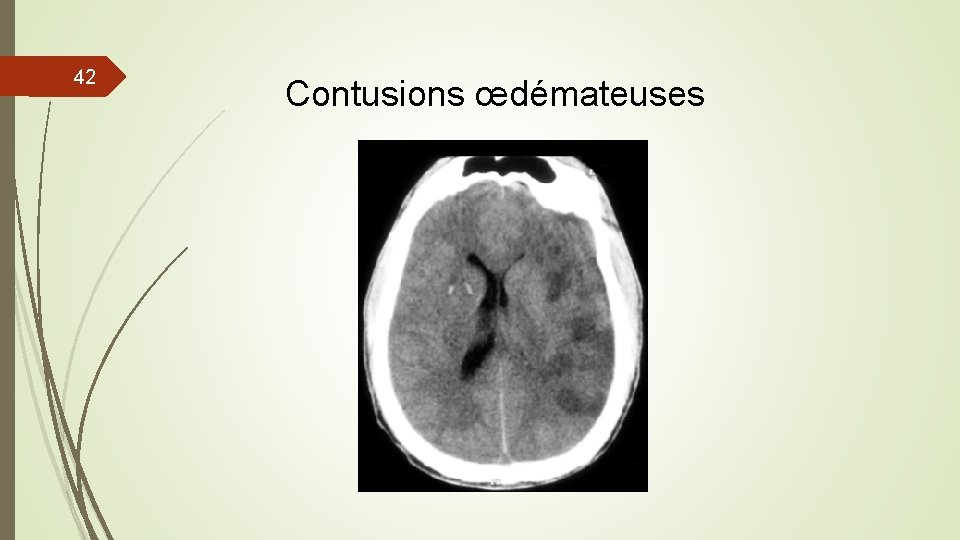 42 Contusions œdémateuses 