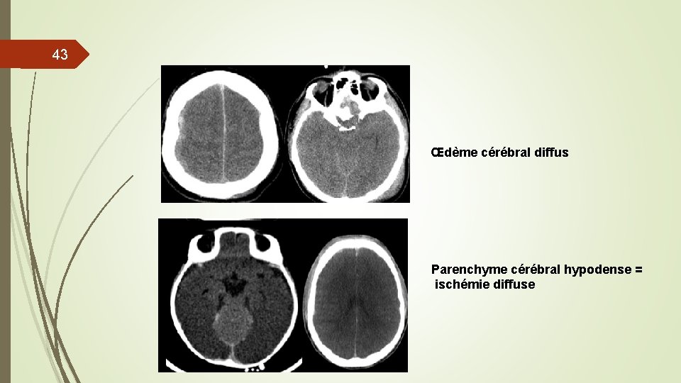 43 Œdème cérébral diffus Parenchyme cérébral hypodense = ischémie diffuse 43 Œdème cérébral diffus Parenchyme cérébral hypodense = ischémie diffuse