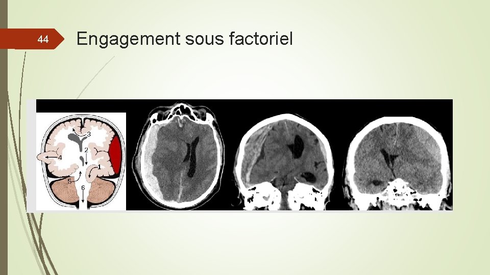 44 Engagement sous factoriel 