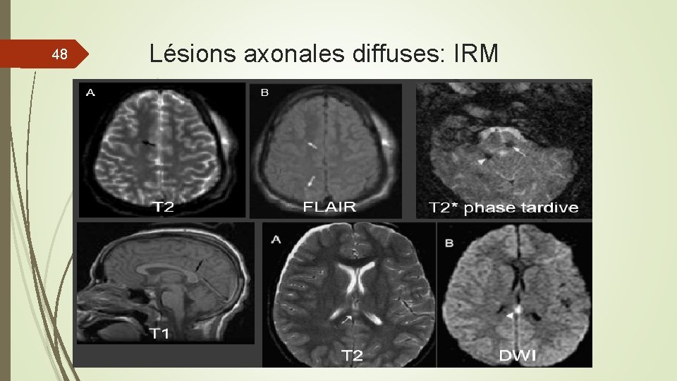 48 Lésions axonales diffuses: IRM 