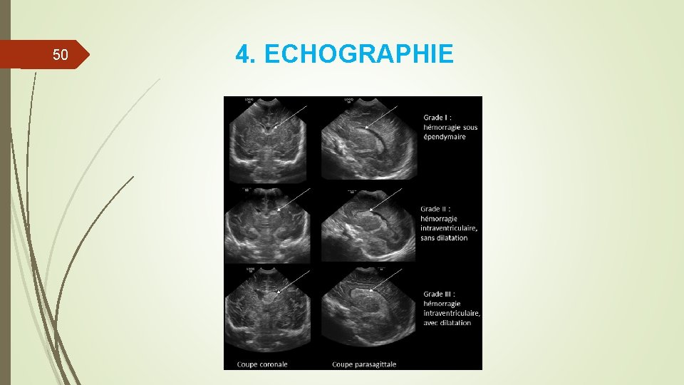 50 4. ECHOGRAPHIE 