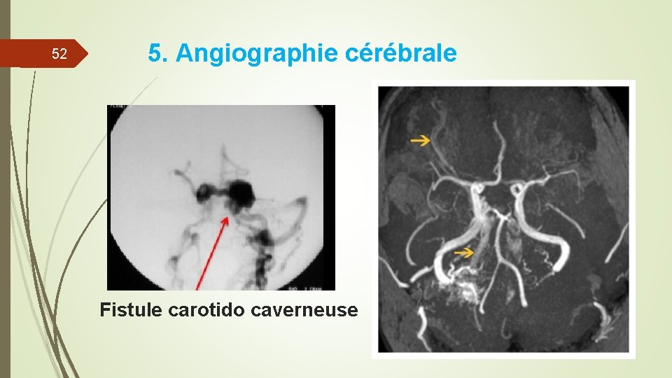 52 5. Angiographie cérébrale Fistule carotido caverneuse 