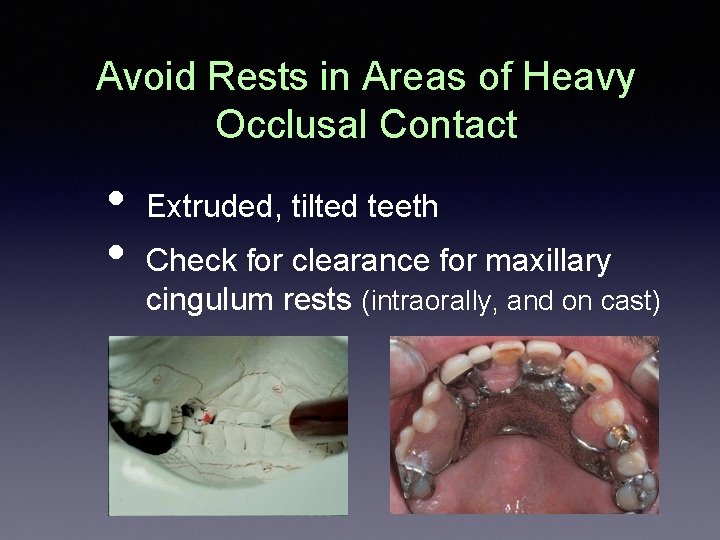 Avoid Rests in Areas of Heavy Occlusal Contact • • Extruded, tilted teeth Check Avoid Rests in Areas of Heavy Occlusal Contact • • Extruded, tilted teeth Check