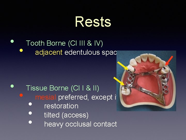 Rests • • Tooth Borne (Cl III & IV) adjacent edentulous space Tissue Borne