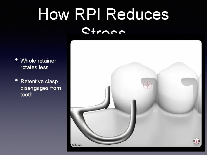 How RPI Reduces Stress • Whole retainer rotates less • Retentive clasp disengages from