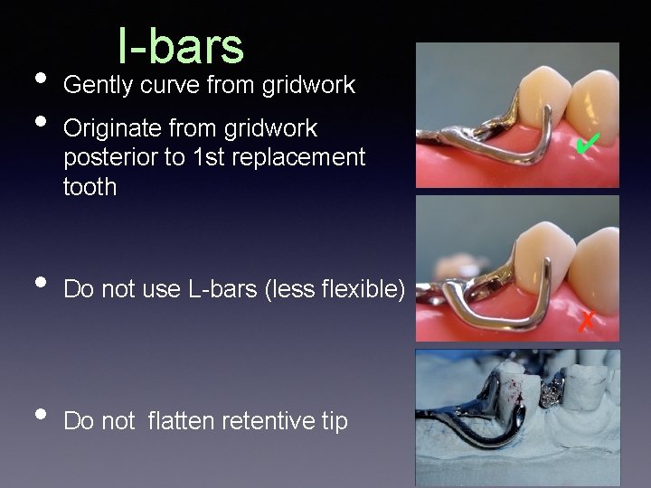  • • I-bars Gently curve from gridwork Originate from gridwork posterior to 1