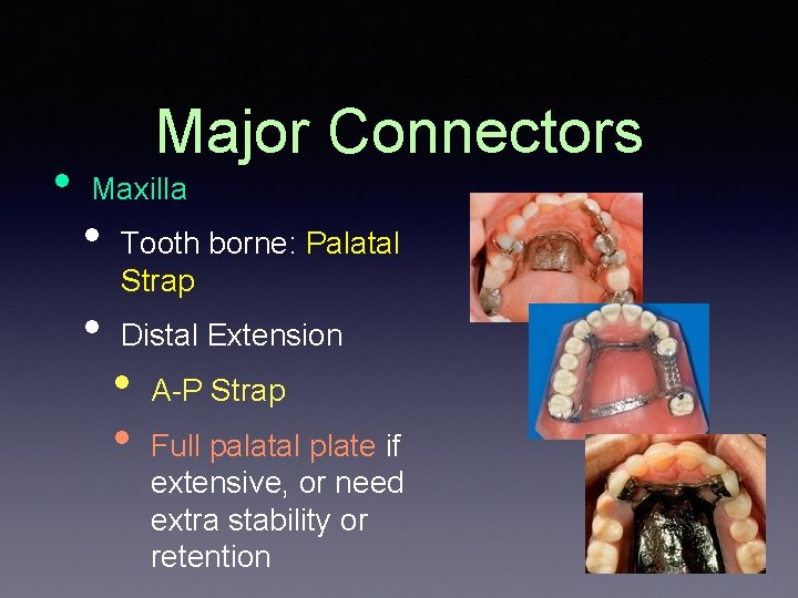  • Major Connectors Maxilla • • Tooth borne: Palatal Strap Distal Extension •