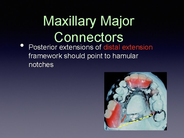  • Maxillary Major Connectors Posterior extensions of distal extension framework should point to