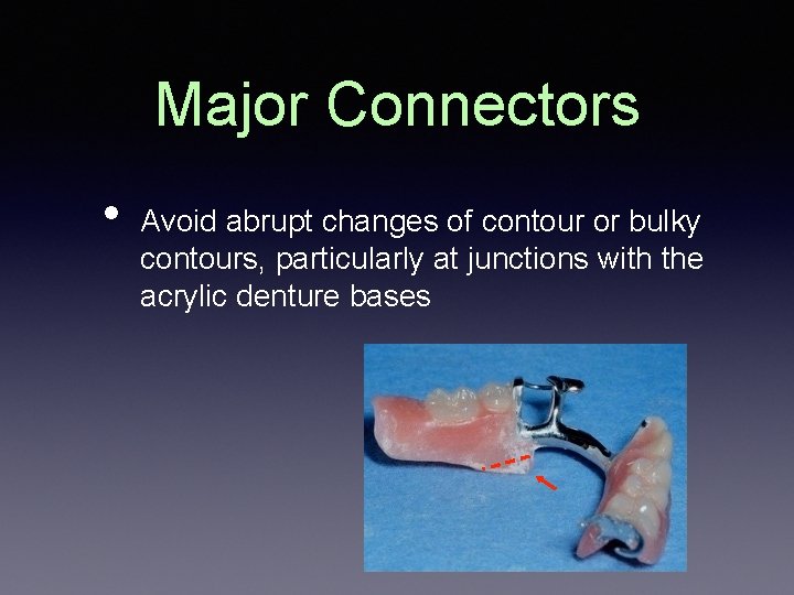 Major Connectors • Avoid abrupt changes of contour or bulky contours, particularly at junctions Major Connectors • Avoid abrupt changes of contour or bulky contours, particularly at junctions