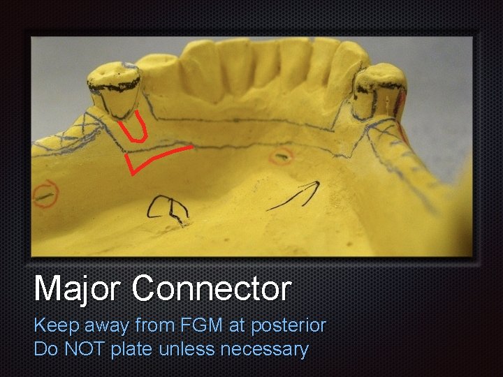 Major Connector Keep away from FGM at posterior Do NOT plate unless necessary Major Connector Keep away from FGM at posterior Do NOT plate unless necessary