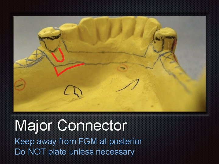 Major Connector Keep away from FGM at posterior Do NOT plate unless necessary 