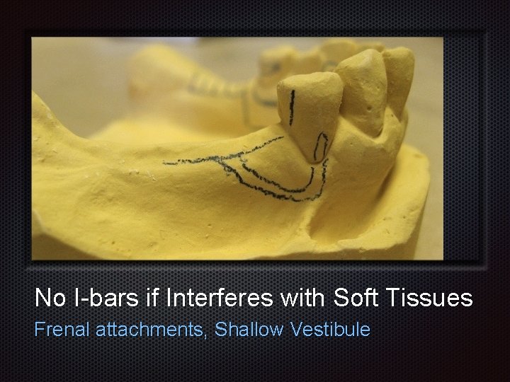 No I-bars if Interferes with Soft Tissues Frenal attachments, Shallow Vestibule 