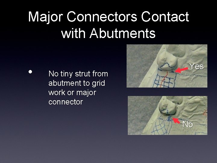 Major Connectors Contact with Abutments • No tiny strut from abutment to grid work Major Connectors Contact with Abutments • No tiny strut from abutment to grid work