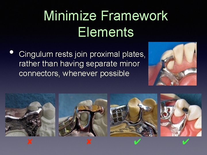 Minimize Framework Elements • Cingulum rests join proximal plates, rather than having separate minor