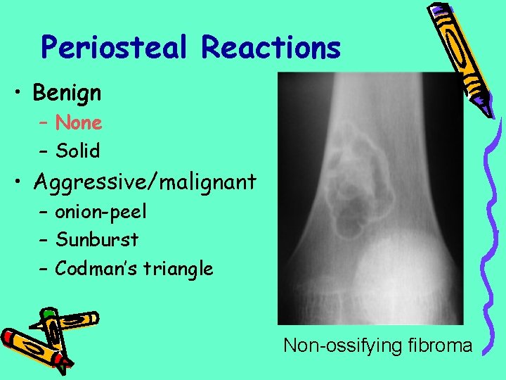Periosteal Reactions • Benign – None – Solid • Aggressive/malignant – onion-peel – Sunburst